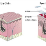 psoriasis_schematic
