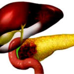 segni_tumore_pancreas