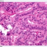 Carcinoma_tiroideo_il_tumore_alla_tiroide_640x480
