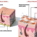 Psoriasi-la-pelle-parla-di-noi_h_partb