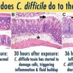 effect-of-c-difficile-on-gut-lining-cells