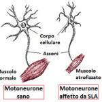 motoneuroni-sla