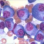 multiple-myeloma