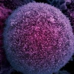 Prostate-cancer-010-720x340