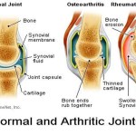 RheumatoidArthritis
