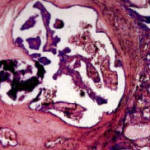 cancro_tiroide_carcinoma_papillare_capsulato
