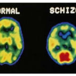 schizofrenia-alterazioni-cerebrali