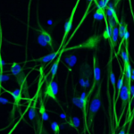 brain-activity-tumor