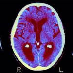 web-alzheimers-2-alamy