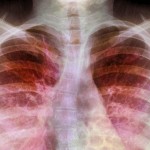 _83028142_c0119708-cystic_fibrosis,_x-ray-spl