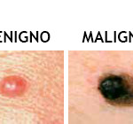 FINALABCMelanoma