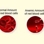 anemia