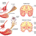 bigstock-alzheimer-55097363