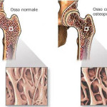 osteoporosi-2