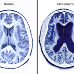 princ_rm_photo_of_alzheimer_brain