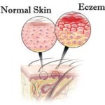 Natural-Eczema-Treatment