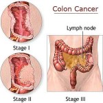 colon-cancer