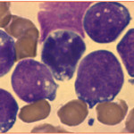 Foà_LEUCEMIA_ACUTA_LINFOIDE_a-cellule_B_mature_Figura_1