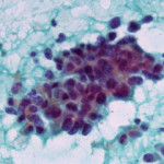 carcinoma