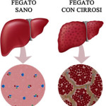 fegato-sano-cirrosi