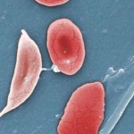 1-sicklecelldi