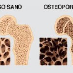 Osteoporosi_180x120