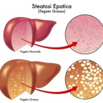 Steatosi epatica