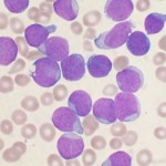 leukemia