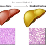 steatosi-epatica