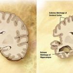1-alzheimersdi