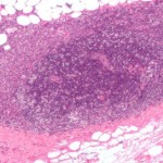 6-breastcancer