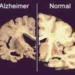 Alzheimer-contronto
