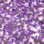 Diffuse_large_B_cell_lymphoma_-_cytology_low_mag