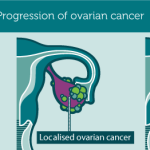 Progression_ovarianCancer1