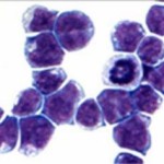 more-paths-to-leukemia