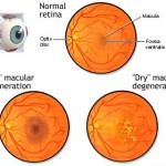 degenerazione maculare secca-esempio