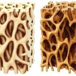osteoporosi
