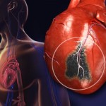 getty_rm_illustration_of_heart_attack