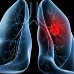 l_4637_lung-cancer-pemetrexed-300x189