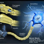 sclerosi_multipla_2_87371