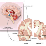 Alzheimers