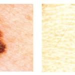 Melanoma-symptom-A_tcm9-234838