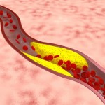 atherosclerosis