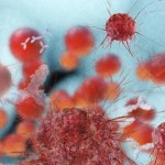 thinkstock-cancer-cell