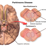 Blausen_0704_ParkinsonsDisease