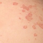 eczema-nummular-300x239