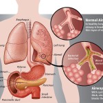 fibrosi-cistica-150505134209