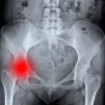 hip-fracture