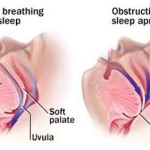 sleep_apnea