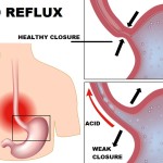 ACIDREFLUX